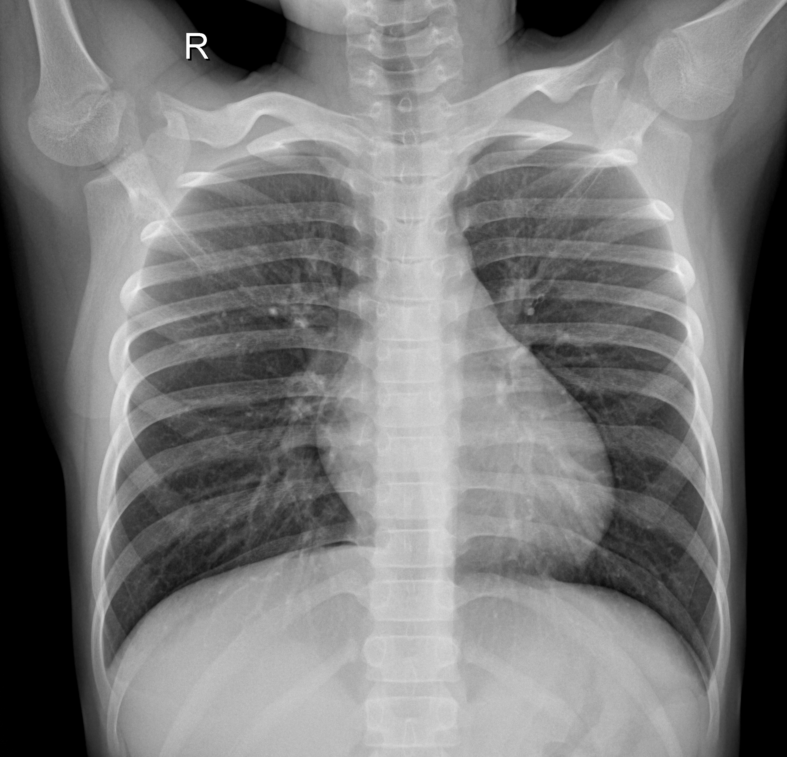Example healthy chest X-ray