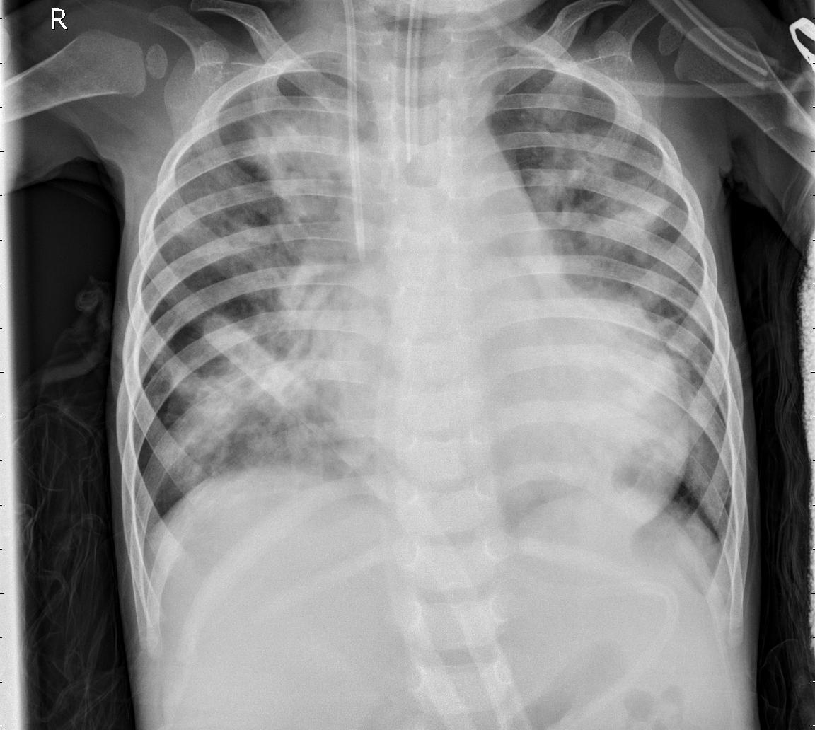 Example chest X-ray showing pneumonia